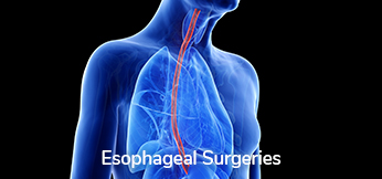 Esophageal Surgeries