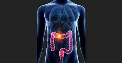 Surgeries for Colon cancer- Colectomy