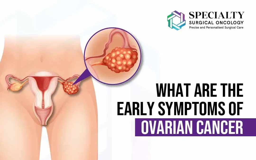 What are the Early Symptoms of Ovarian Cancer?