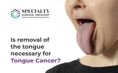 Is removal of the tongue necessary for tongue cancer?