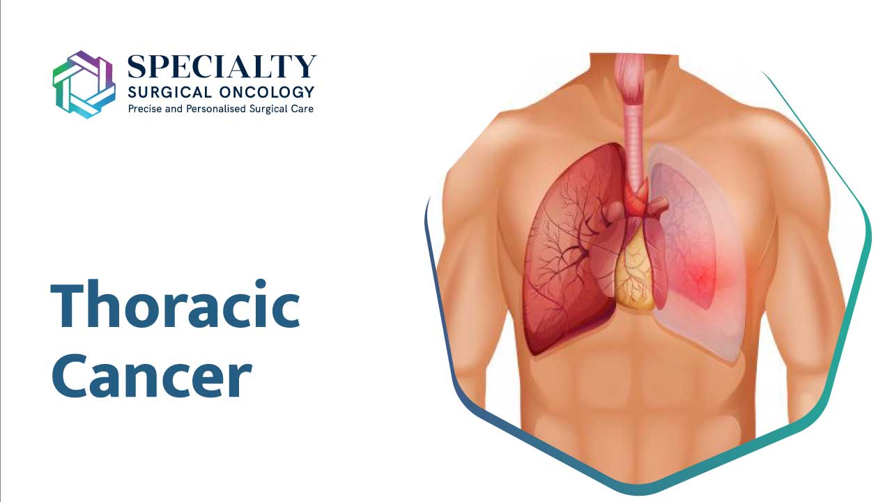 Thoracic Cancer<br />
