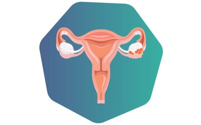 4 Best Tips to Reduce the Risk of Ovarian Cancer