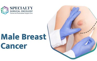 Early-Stage Male Breast Cancer