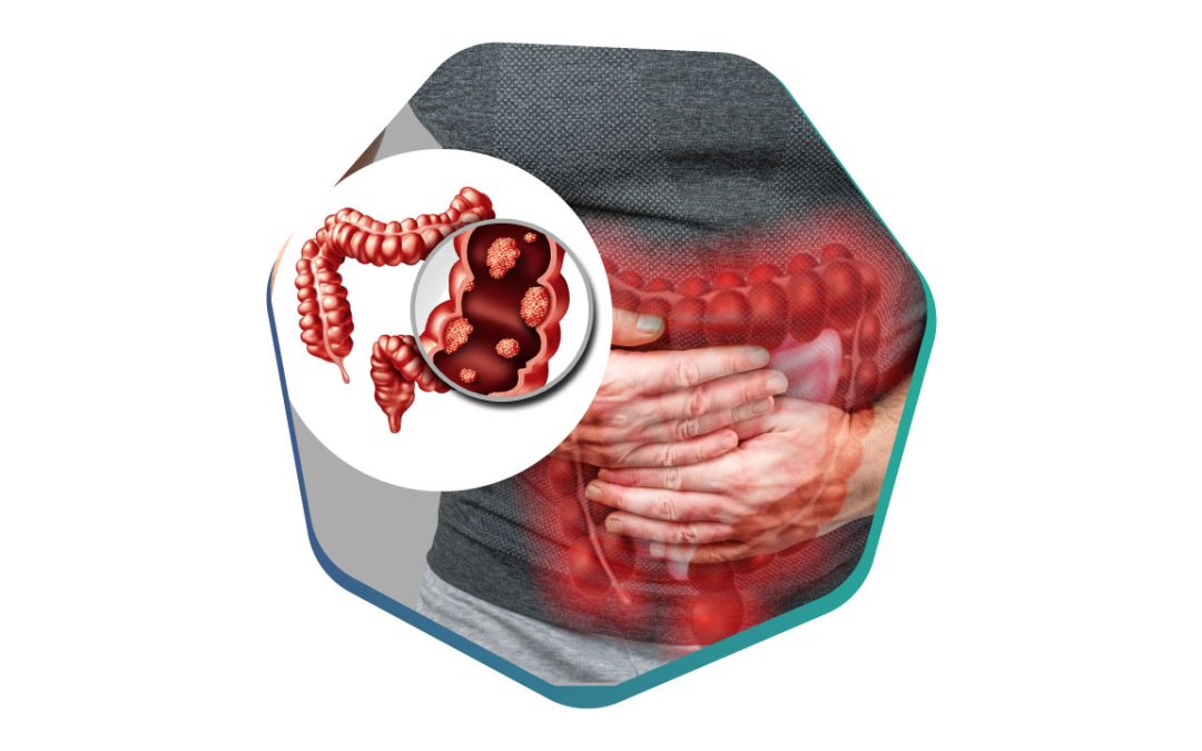 Six Ways to Prevent Colorectal Cancer