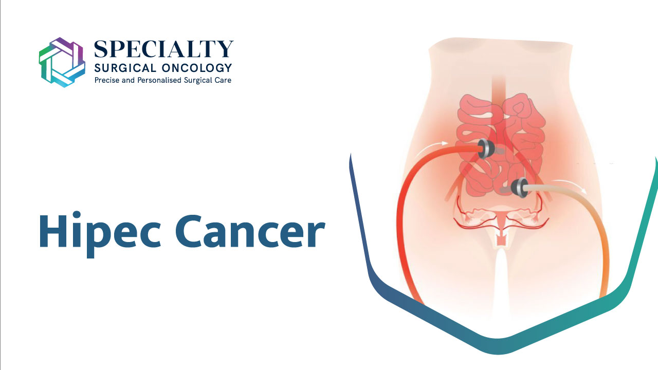 Best HIPEC Treatment Hospital in Mumbai