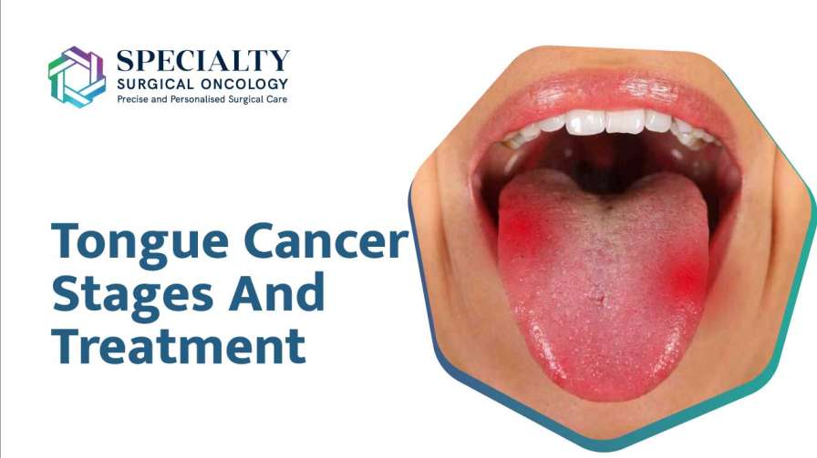 Tongue Cancer Stages And Treatment<br />
