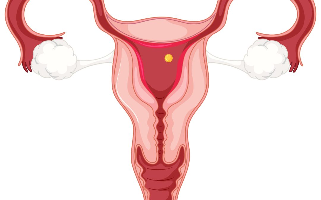 What is an Endometrial Biopsy?