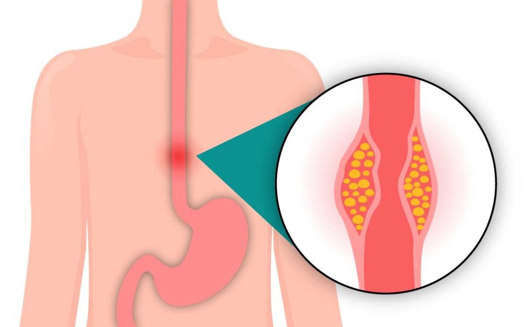 Esophageal cancer – Signs and Symptoms
