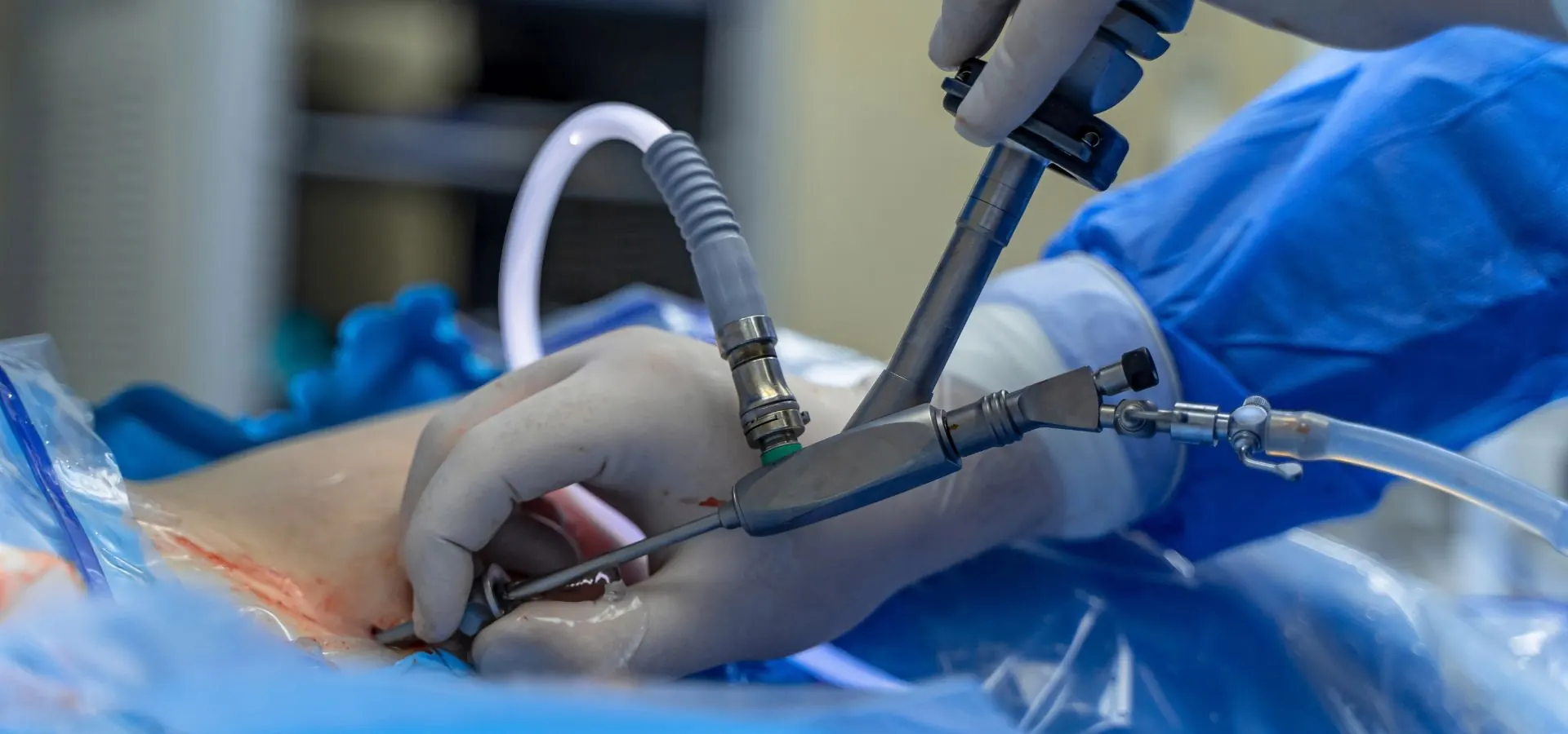 Surgeons holding a laparoscopic camera and instruments during minimally invasive cancer surgery